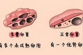 多囊卵巢其实是痰湿把冲脉堵住了，张仲景有一千古名方，专克此症图片