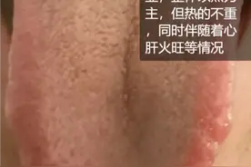 舌中裂纹越重，小心寿命越短！常见的4大裂纹舌，一次给你讲明白图片