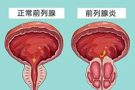 经常“打飞机”？小心‘乐’极生悲，尿频尿急、尿痛都找上门！图片
