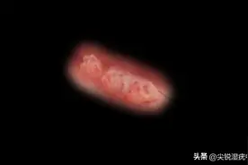 男性尖锐湿疣不治会怎么样？图片