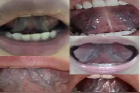 舌下青筋又黑又粗？这是血瘀严重，如何选择中成药调理？一文说清图片