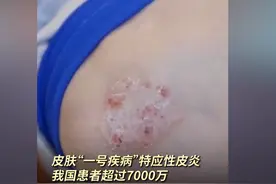 皮肤科瘙痒界的“一号疾病”，难缠又反复，中国每年超7000万患者图片