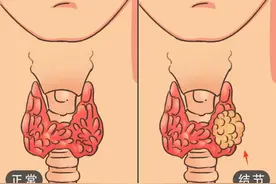 五分钟了解甲状腺结节图片