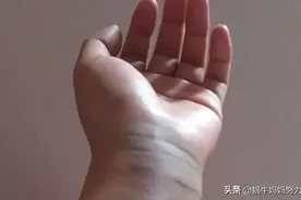 手掌摔伤后，千万不能做的一件事图片