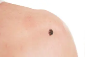有些痣会癌变，这几个信号千万别忽略！教您自查找出黑色素瘤图片