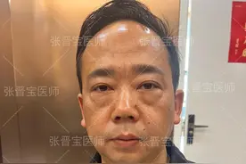 40岁狠心做了眼袋手术，躺下40分钟，眼睛一睁，即刻状态让我惊喜图片