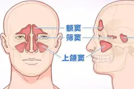 玉屏风散+苍耳子散，腺样体肥大、鼻窦炎一起调图片