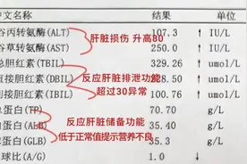 肝硬化只要不出现这5种情况，那你的肝还不错图片