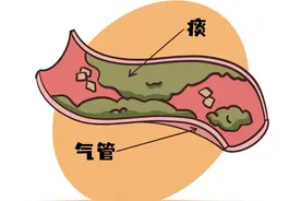 痰堵在气管差点被送走！学会这2招排痰法能救命图片