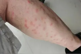 太惨了！今年第一批中招的人出现了！不少杭州人晒出照片图片