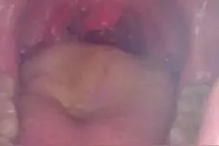 小男孩偷吃太多冰激凌，导致喉咙发炎了，真是太难了图片