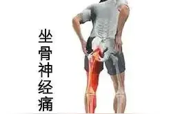 这是一个使用甘姜苓术汤治愈顽固性坐骨神经痛的病案图片