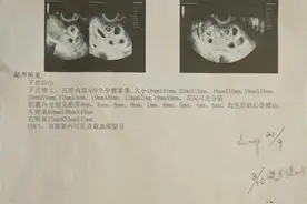 罕见！25岁女子怀上9胞胎图片