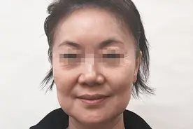 5小时高铁去北京做拉皮，术后9天像换了张脸，52岁看着像32岁！图片