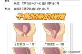 难言之隐——认识子宫脱垂。图片
