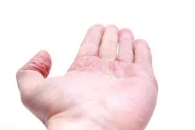科普大讲堂：缠人的湿疹，让人痒的受不了！怎么止痒？图片