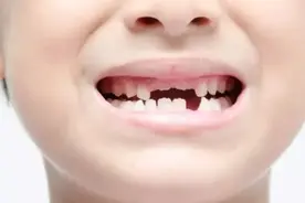 孩子换牙期，都需要注意什么？图片