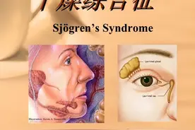 这个被治愈的干燥综合征案例，让她对我这种治疗方法刮目相看！图片