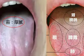 嗓子里有东西又咳不出来，莫名其妙有淤青，小心“痰淤互结”体质图片