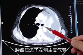 肺癌之王—小细胞肺癌，7次化疗几近崩溃，换方案后挺过三年！图片
