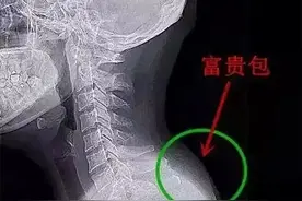治疗富贵包，针灸有妙招图片