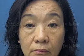68年的56岁，在郑州做了拉皮、精雕、提眉，朋友都认不出来我了。图片