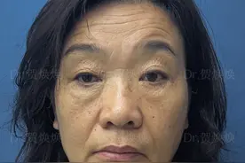 68年的56岁，在郑州做了拉皮、精雕、提眉，朋友都认不出来我了。图片