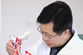 颈椎反弓了，还能恢复到正常曲度吗？需要手术吗？图片