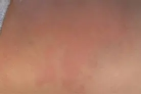 荨麻疹真受罪，第一年得，第二年又犯了，自己艾灸后再没犯过图片