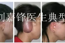 小耳畸形耳再造全包法优势是什么？双侧耳朵可以同时一起吗？图片