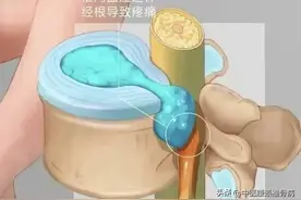 问：腰突症的突出物能推回去吗？图片
