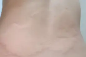 把人逼疯的荨麻疹图片