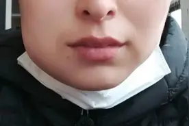 早上起床脸肿，可能是3种疾病的信号，建议了解图片