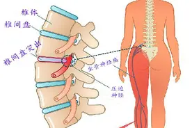 腰椎间盘突出，怎么办？图片