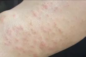 湿疹这样治，简洁明了，不怕它不好图片
