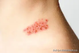 得了带状疱疹怎么办 ？科学使用6类药物，积极修复受损神经图片