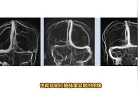 静脉窦发育变异影像你都认识了吗？别误诊了！图片