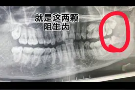 第一次拔智齿全过程：第一天#熬过了就好了图片