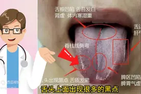 舌质有黑点？舌两边鼓胀？气滞、血瘀，教你辩证舌象分析图片