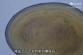 小腹胀痛前列腺炎病友，排出前列腺结石图片