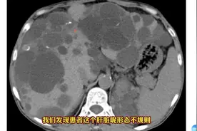 多囊肝典型影像表现，和单纯肝囊肿有何区别？医生讲解！图片