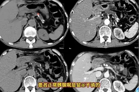 慢性胰腺炎典型CT表现，抓住典型征象，轻松诊断！ #医学影像图片