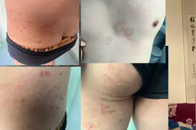 30多岁，全身多发性红斑瘙痒好几年了，皮肤美容科医生告诉你图片