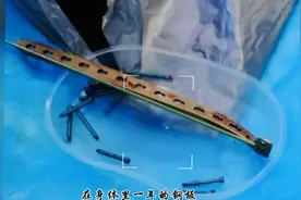 陪伴我一年的钢板，顺利取下来了，熬过了两次疼痛，一切都...图片