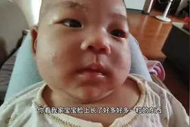 脸上长湿疹或热疹大家都是怎么处理的呢图片
