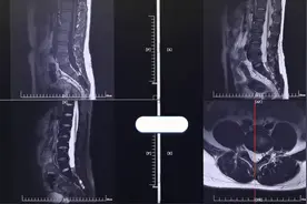 MRI所示腰椎间盘突出（中央型） #医学生图片