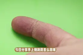 手上倒刺频发，原来是津液不足惹的祸！图片