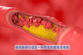 胞二磷胆碱治疗脑动脉硬化症疗效分析图片