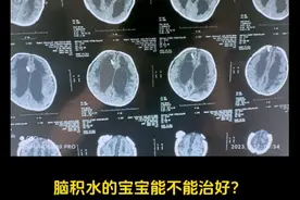 脑积水的宝宝能治好吗？ #脑积水 #宝宝头型 #医学科普 #育儿知识 #硬核健康科普行动视频封面