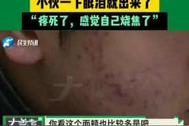 中医用烧得通红的火针治“青春痘”，小伙一下眼泪就出来了，“疼死了，感觉自己烧焦了”#常识中国视频封面